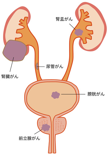 悪性 腫瘍