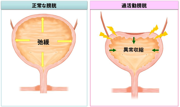 神経 因 性 膀胱 と は