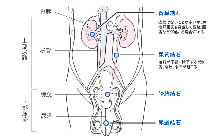 結石 症状